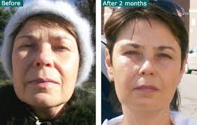 Before and After Light Therapy