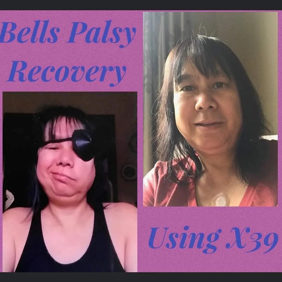 Bells Palsy Testimony